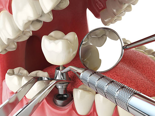 Best Emergency Dental Care for Sports Injuries in Crystal Lake, IL